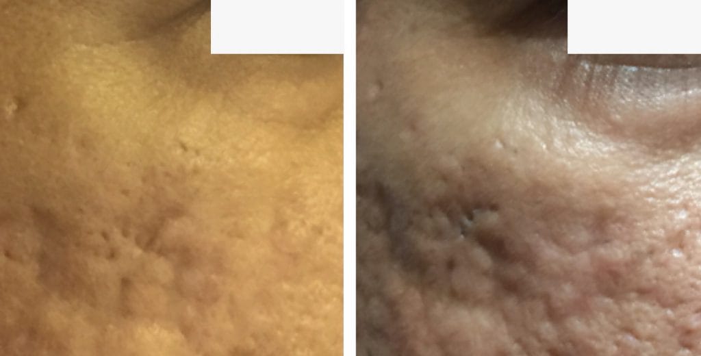 Skin resurfacing London before and after 1