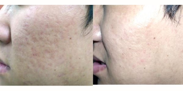  scar treatment Before and after 1