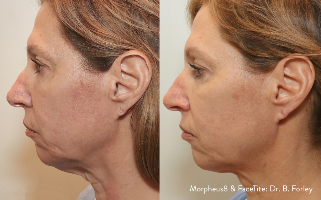 Jawline sculpting, Before and After picture 1