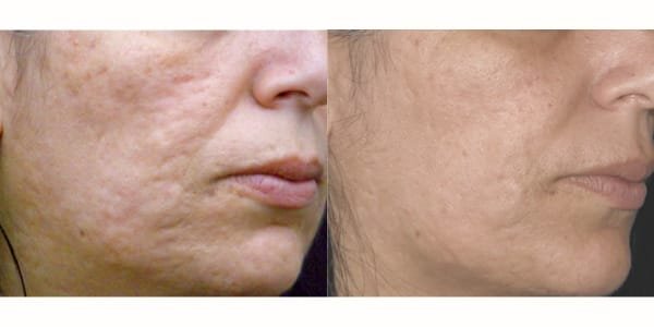 before and after scar treatment on cheeks