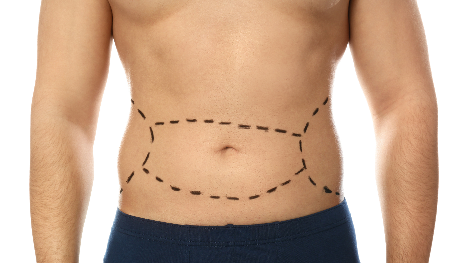 tummy tuck for men